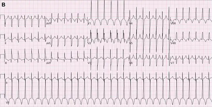 JET in a 2-month-old girl following cardiac surgery. In this case the right bundle branch block was present during tachycardia and during normal sinus rhythm.