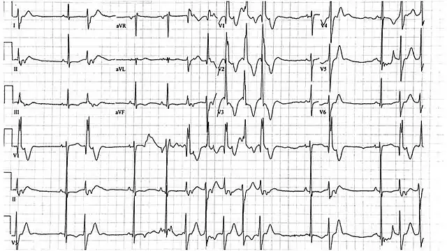 Electrocardiogram showing bidirectional Ventricular Tachycardia in a 9-year-old female with Andersen–Tawil syndrome