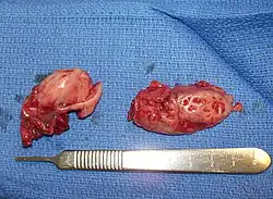Cryptic tonsils immediately following surgical removal (bilateral tonsillectomy).