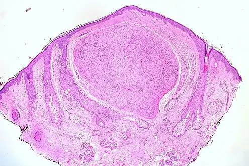 Palisaded and Encapsulated Neuroma