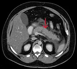Acute exudative pancreatitis on CT scan