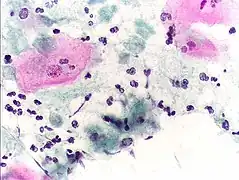 Pap smear, showing infection by Trichomonas vaginalis. Papanicolaou stain