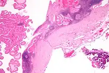 Low magnification micrograph of a Warthin tumor arising from the parotid gland.