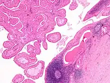 Intermediate magnification micrograph of a Warthin tumor.