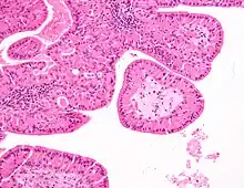 High magnification micrograph of a Warthin tumor showing the characteristic bilayered epithelium.