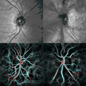Papilledema (right) revealed by scanning laser ophthalmoscopy (top) and laser Doppler imaging (bottom). Healthy contralateral eye (left).