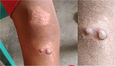 Here two different appearances (papulosquamous plaque and yellow-crusted nodules) are seen in the same 10-year-old person (large-scale of both, close-up of nodules)