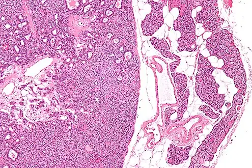 Micrograph of a parathyroid adenoma (left) and normal parathyroid gland (right). H&E stain.