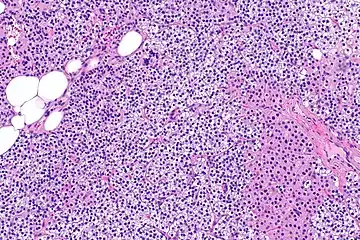 Parathyroid hyperplasia medium mag.