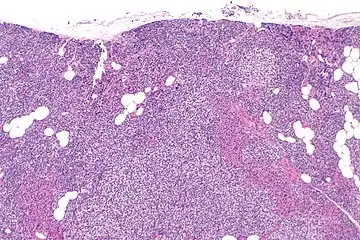 Parathyroid hyperplasia low mag.