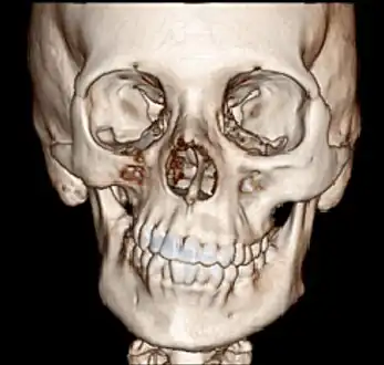 CT scan3D bone reconstruction of a 17-year-old girl with Parry Romberg syndrome.