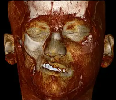 A 3D, soft tissue reconstruction of a CT scan of a 17-year-old girl with Parry Romberg syndrome.