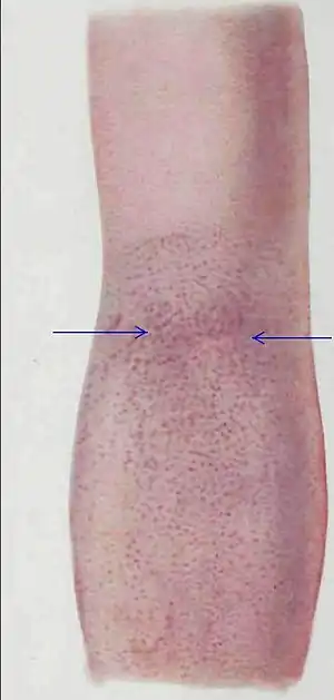 Intense redness in skin folds