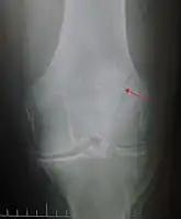 Vertical patella fracture