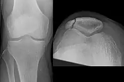 Osteochondral fracture of patella