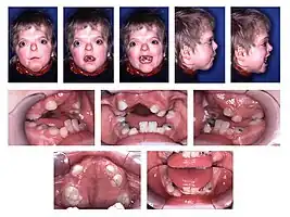 Teeth of a child with Apert syndrome