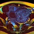 MRI image with multiple uterine leiomiyomas