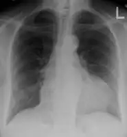 A pericardial effusion as seen on CXR in someone with pericarditis