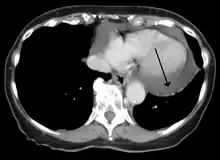 A CT scan image showing a pericardial effusion