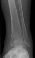 Periosteal reaction from venous stasis