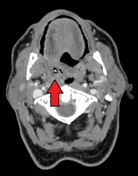 Peritonsillar abscess on the person's right as seen on CT imaging