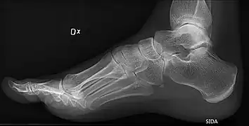 Foot with pes cavus (and os peroneum).