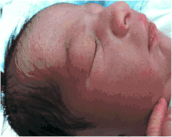 Petechiae on face due to tight nuchal cord