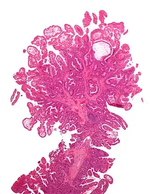 Micrograph of a Peutz–Jeghers colonic polyp – a type of hamartomatous polyp. H&E stain.