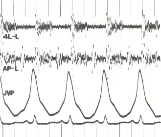Phonocardiogram and jugular venous pulse tracing from a middle-aged man with pulmonary hypertension caused by cardiomyopathy. The jugular venous pulse tracing demonstrates a prominent a wave without a c or v wave being observed. The phonocardiograms (fourth left interspace and cardiac apex) show a murmur of tricuspid insufficiency and ventricular and atrial gallops.