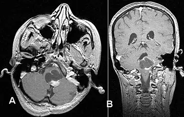 Stereotactic MRI brain scan showing a recurrent postoperative brain stem cystic pilocytic astrocytoma.