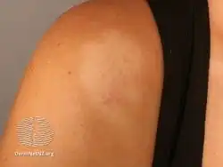 Pityriasis alba shoulder