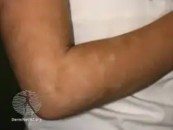 Pityriasis alba arm