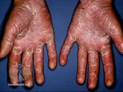 Pityriasis rubra pilaris