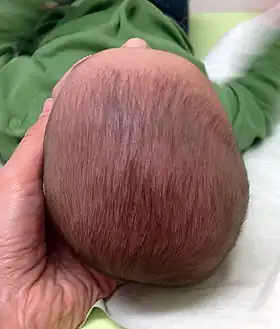 Left posterior positional plagiocephaly in a baby
