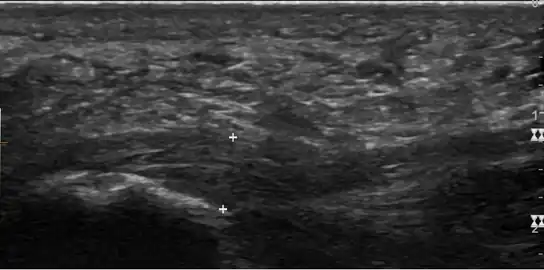 Thickened plantar fascia in ultrasound