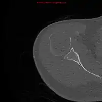 1.b. CT scan: solitary plasmacytoma upper arm near shoulder