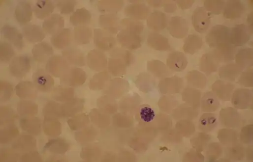 Blood smear from a P. falciparum culture (K1 strain - asexual forms) - several red blood cells have ring stages inside them. Close to the center is a schizont and on the left a trophozoite.