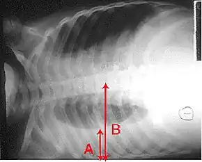An X-ray showing a chest lying horizontal. The lower black area, which is the right lung, is smaller with a whiter area below it of a pulmonary effusion. There are red arrows marking the size of these.