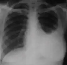 Chest x-ray showing dense opacity pleural effusion in the lower left lung of primary pulmonary TB.