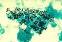 Cysts of P. jiroveci in smear from bronchoalveolar lavage. Methenamine silver stain.