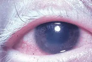 Uveitis with poliosis of the eyelashes