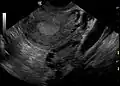 Transvaginal ultrasound scan of polycystic ovary