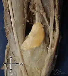 A specimen from a cadaver of a Baker's cyst in popliteal space