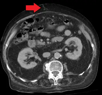 Portal hypertension due to cirrhosis resulting in revascularization of the umbilical vein