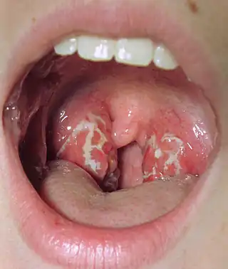 A culture positive case of streptococcal pharyngitis with typical tonsillar exudate in a 16-year-old.