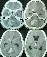 Axial CT scan showing hemorrhage in the posterior fossa