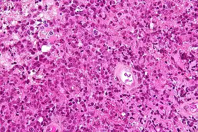 Micrograph showing a primary CNS lymphoma with the characteristic perivascular distribution composed of large cells with prominent nucleoli. Brain biopsy. HPS stain.