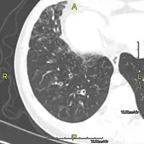 CT image showing dilated and thickened medium-sized airways (bronchiectasis) in a patient with Kartagener syndrome