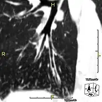 Oblique sagittal CT image showing lower lobe cylindrical bronchiectasis