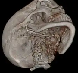 3D reconstructed CT scan showing elongated styloid process (right side)